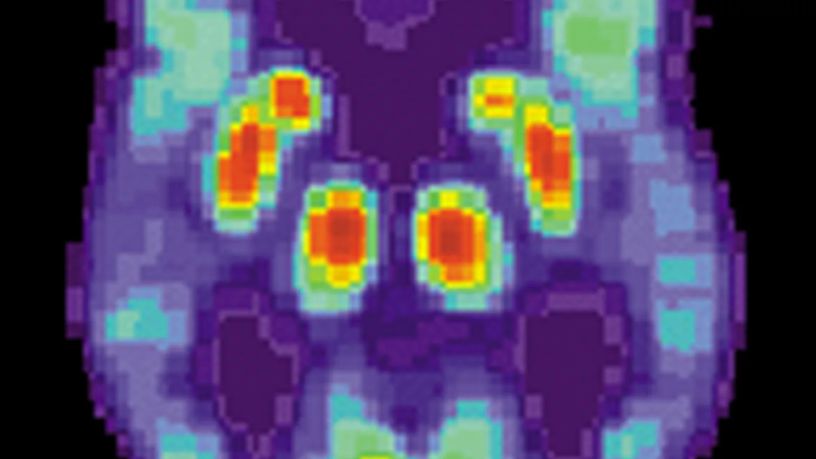 PET Alzheimer.jpg. Ilustracija uz vest: AI analiza FDG-PET snimaka traži mrežne obrasce povezane sa Alchajmerovom bolešću
